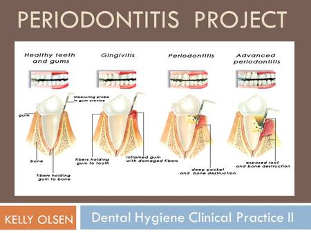 Periodontitis Project