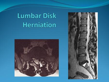 35 and 45 years age Risk factor – Smoking sedentary work motor vehicle driving Sciatica, characterized by pain radiating down the leg in.