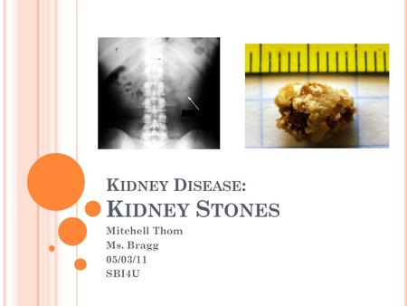 K IDNEY D ISEASE : K IDNEY S TONES Mitchell Thom Ms. Bragg 05/03/11 SBI4U.