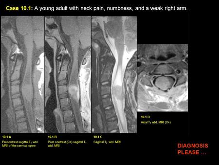 Case 10.1: A young adult with neck pain, numbness, and a weak right arm. Axial T1 wtd. MRI (C+) 10.1 A 10.1 B 10.1 C Precontrast sagittal T1 wtd. MRI of.