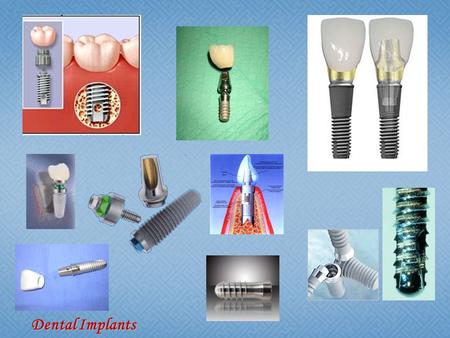 Dental Implants.