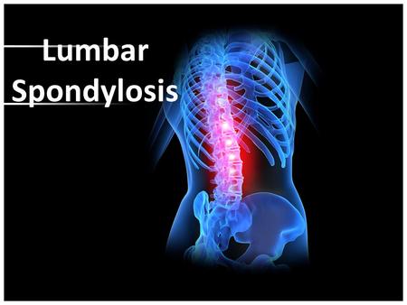 Lumbar Spondylosis.