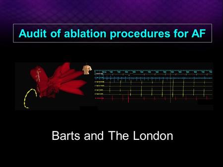 Audit of ablation procedures for AF Barts and The London.