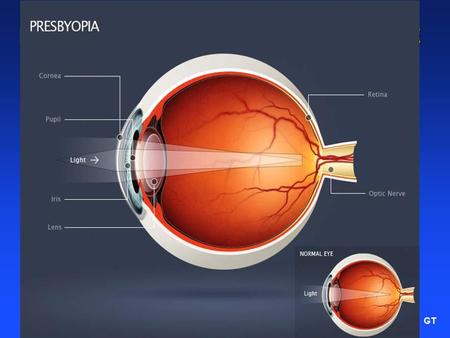 GT BOGOTA LASER REFRACTIVE INSTITUTE BOGOTA COLOMBIA SOUTHAMERICA GUSTAVO E. TAMAYO MD BASIC PRINCIPLES OF PRESBYOPIA.