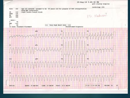 WIDE COMPLEX TACHYCARDIA