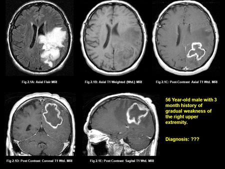 Fig 2.1B: Axial T1 Weighted (Wtd.) MRIFig 2.1A: Axial Flair MRIFig 2.1C: Post-Contrast Axial T1 Wtd. MRI Fig 2.1D: Post Contrast Coronal T1 Wtd. MRIFig.