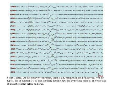 Stage II sleep. On this transverse montage, there is a K-complex in the fifth second, with its typical broad duration (>500 ms), diphasic morphology, and.