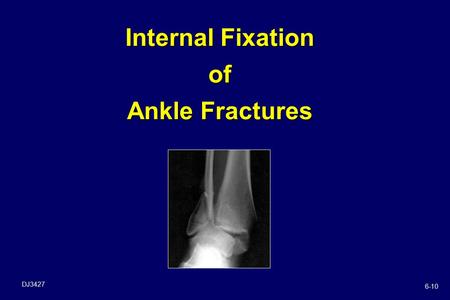 Internal Fixation of Ankle Fractures