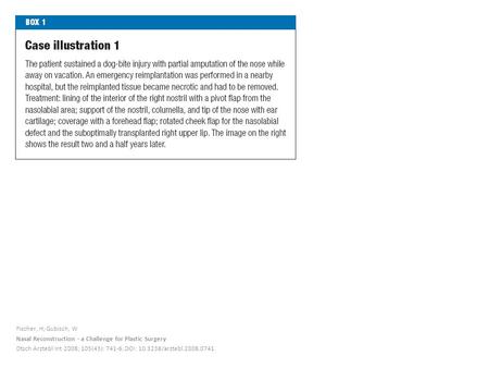 Fischer, H; Gubisch, W Nasal Reconstruction - a Challenge for Plastic Surgery Dtsch Arztebl Int 2008; 105(43): 741-6, DOI: 10.3238/arztebl.2008.0741.