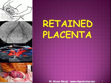 RETAINED PLACENTA Dr Mona Shroff www.obgyntoday.info.