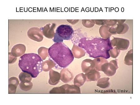 LEUCEMIA MIELOIDE AGUDA TIPO 0