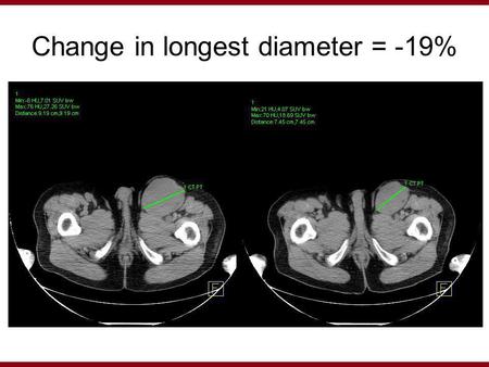 Change in longest diameter = -19%. Change in sum of perpendicular diameters = -21%