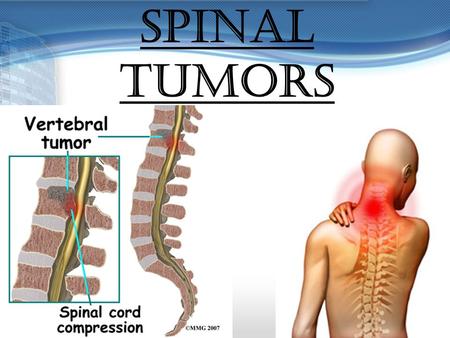 SPINAL TUMORS. GROUP MEMBERS:  Carlwyn Collins  Jennifer Haynes  Satrupa Devi Singh  Vanessa Wickham.