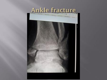  Deltoid Ligaments  Fibula  Medial malleolus  Posterior malleolus.