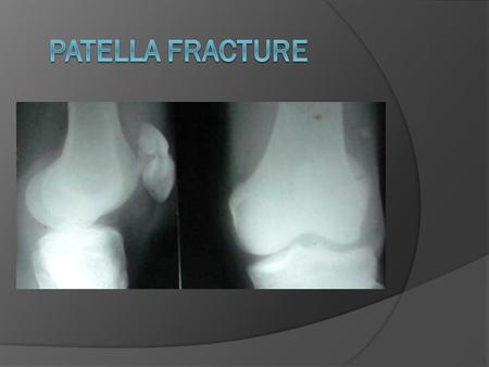 Mechanism of the Injury (cause)  Fall or hit on to knee cap.