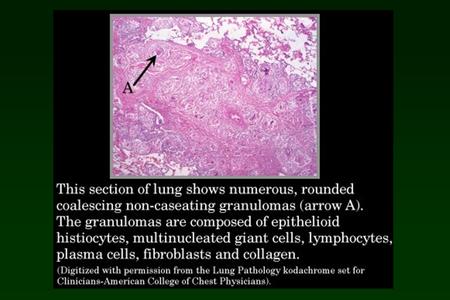 Bronchiolitis Obliterans with Organizing Pneu- monia (BOOP). HRCT shows multi- focal areas of hazy increase in lung density, and associated peripheral.