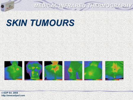 © EDP Srl, 2004  SKIN TUMOURS.