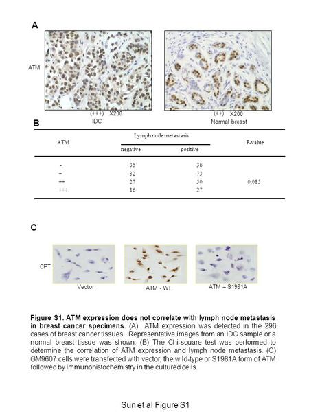 (+++) Normal breast ATM (++) IDC ATM Lymph node metastasis negative positive P-value - + ++ +++ 35 32 27 16 36 73 50 27 0.085 A B X200 C Vector ATM - WT.