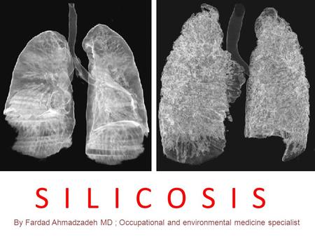 SILICOSIS S I L I C O S I S By Fardad Ahmadzadeh MD ; Occupational and environmental medicine specialist.