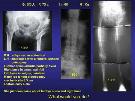 G. BOU. F. 75 y. 1 m60 61 Kg R.H : ankylosed in adduction L.H : dislocated with a femoral Schanz osteotomy Lumbar spine arthritic partially fixed Right.