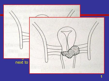 Stage II Stage II - Invasive cancer with tumor extending beyond the cervix and/or the upper two-thirds of the vagina, but not onto the pelvic wall. –Stage.