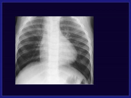 Tetrology of Fallot Cyanosis Decreased Pulmonary Vascularity Normal Cardiac size 8 percent of Congenital heart disease 4 Components.