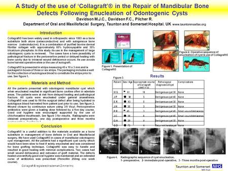 Introduction Collagraft® has been widely used in orthopaedic since 1993 as a bone substitute both alone (osteoconductive) and with autogenous bone marrow.