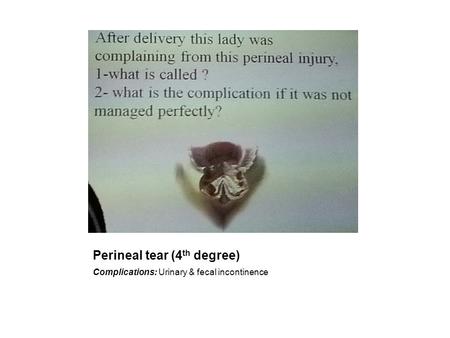 Perineal tear (4th degree)