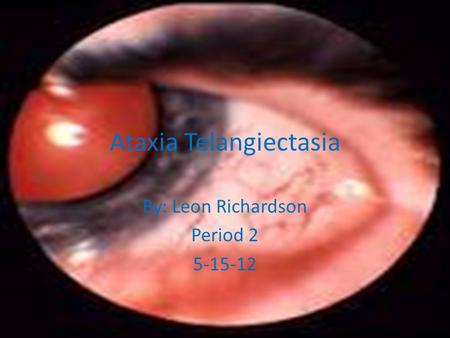 Ataxia Telangiectasia By: Leon Richardson Period 2 5-15-12.