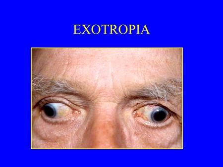 EXOTROPIA. DR. LIONEL KOWAL FRANZCO, FRACS MELBOURNE, AUSTRALIA.