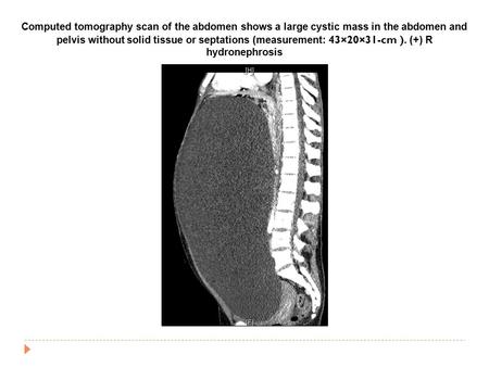 Computed tomography scan of the abdomen shows a large cystic mass in the abdomen and pelvis without solid tissue or septations (measurement: 43×20×31-cm.