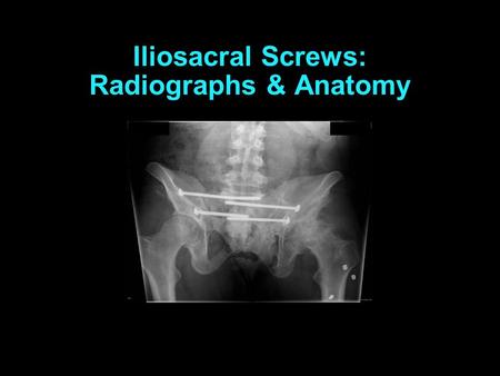 Iliosacral Screw “Safe Zone”