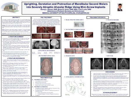 ABSTRACT Moving teeth into severely atrophied alveolar ridges with conventional Edgewise set- ups is problematic due to possible bone dehiscence, root.