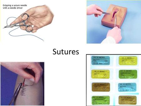 Sutures.