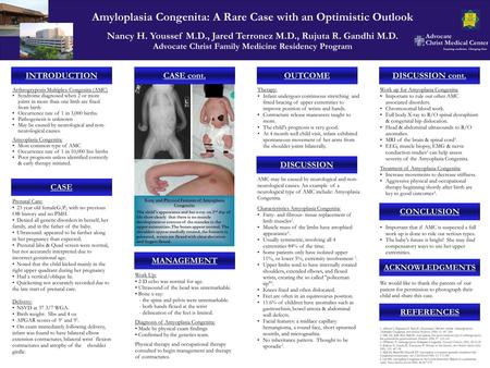 Arthrogryposis Multiplex Congenita (AMC) Syndrome diagnosed when 2 or more joints in more than one limb are fixed from birth Occurrence rate of 1 in 3,000.