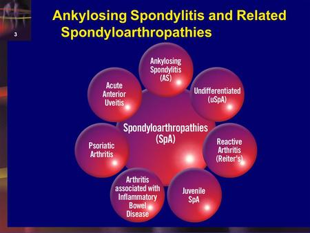 Ankylosing Spondylitis and Related Spondyloarthropathies