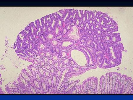 Familial Adenomatous Polyposis (FAP) Most common, 1:10,000 individuals Most common, 1:10,000 individuals Risk of CA of affected patients: 100% Risk.