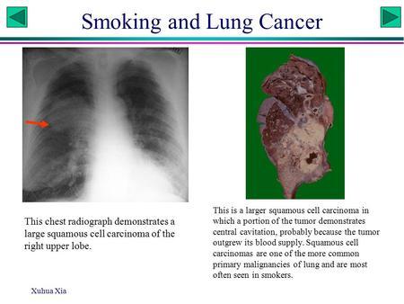 Xuhua Xia Smoking and Lung Cancer This chest radiograph demonstrates a large squamous cell carcinoma of the right upper lobe. This is a larger squamous.