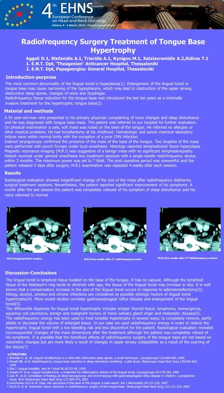 Radiofrequency Surgery Treatment of Tongue Base Hypertrophy Aggeli D.1, Stefanidis A.1, Triaridis A.1, Kynigou M.1, Xatziavramidis A.2,Sidiras T.1 1. E.N.T.