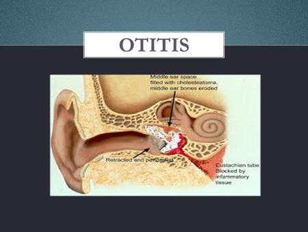 OTITIS.