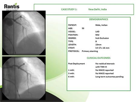 DEMOGRAPHICS PATIENT:Male, Indian AGE:53 VESSEL: LAD POSITION:Mid DEGREE:Sub Occlusion TYPE:B LENGTH:13mm STENT:3.5  x 16 mm PROTOCOL:Primary stenting.