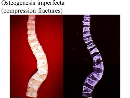 Osteogenesis imperfecta (compression fractures). OI-blue sclera.