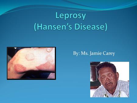 Leprosy (Hansen’s Disease)