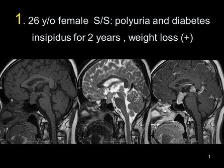 1 1. 26 y/o female S/S: polyuria and diabetes insipidus for 2 years, weight loss (+)