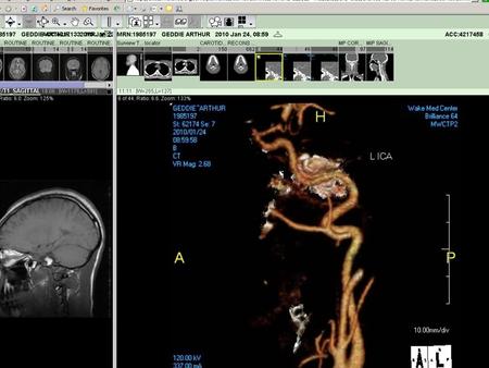 CAROTID DISSECTION Morning Report July 12, 2010 Ann Isaksen.