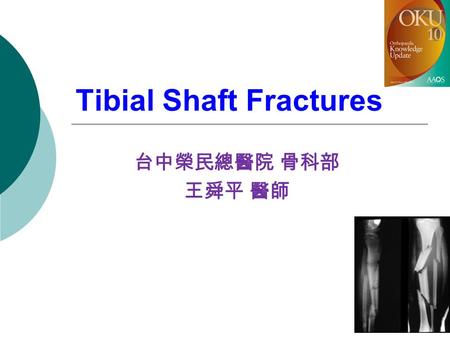 Tibial Shaft Fractures