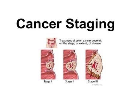 Cancer Staging.