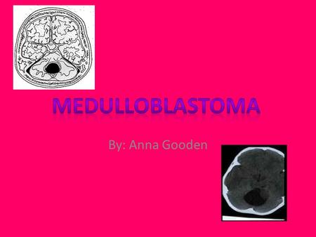 By: Anna Gooden. Medulloblastoma Medulloblastoma is a type of brain tumor. It is also known as PNET. It occurs in children and teenagers.