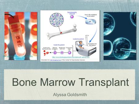 Bone Marrow Transplant Alyssa Goldsmith  cells-research.html  due-australian-stem-cell-research-