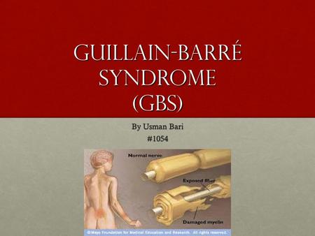 Guillain-Barré syndrome (GBS)